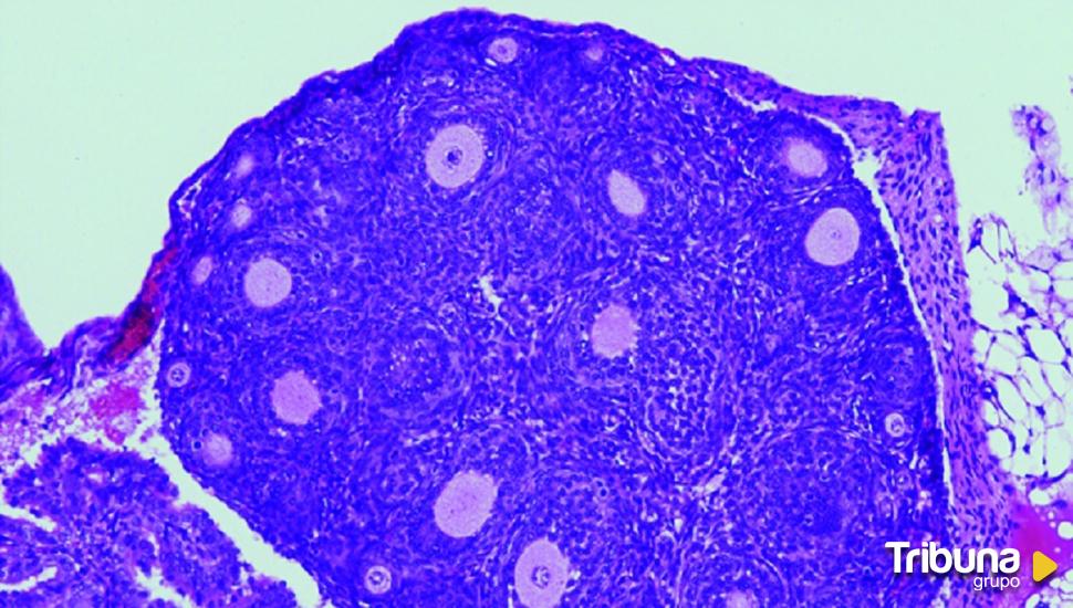 El Centro del Cáncer descubre que la mutación de un gen desencadena el desarrollo de un tipo de cáncer de ovario